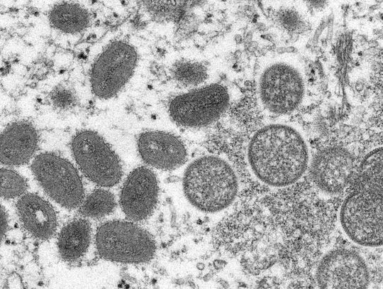 Harris County resident with monkeypox dies, marking first death in the U.S. linked to the virus