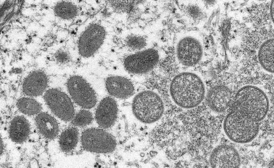 Harris County resident with monkeypox dies, marking first death in the U.S. linked to the virus